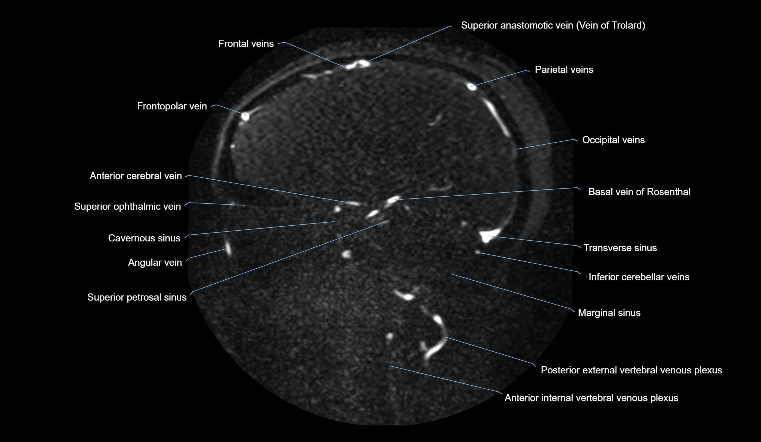 MRV brain sagittal anatomy 3T MRI labelledimages -00050.webp